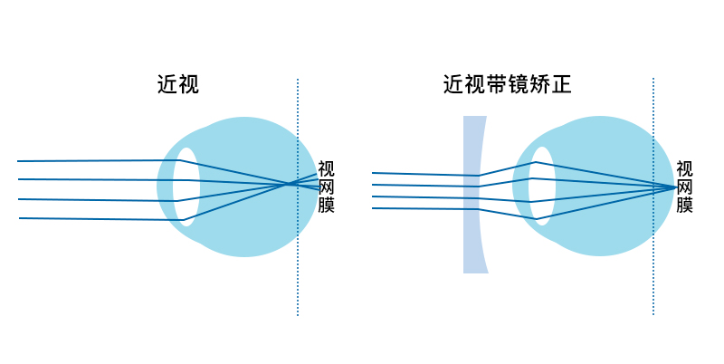 1.0以下视力属于近视吗,裸眼视力0.1等于近视多少度