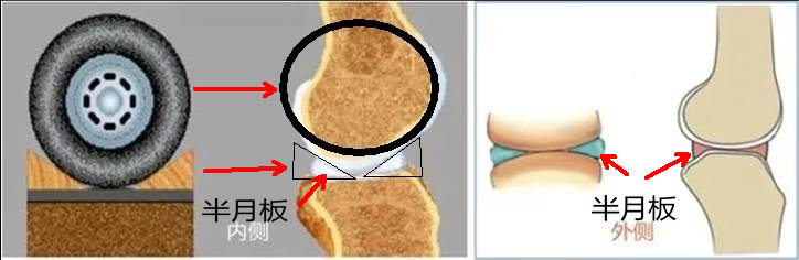 半月板损伤严重的状态是什么,半月板损伤应该注意什么问题