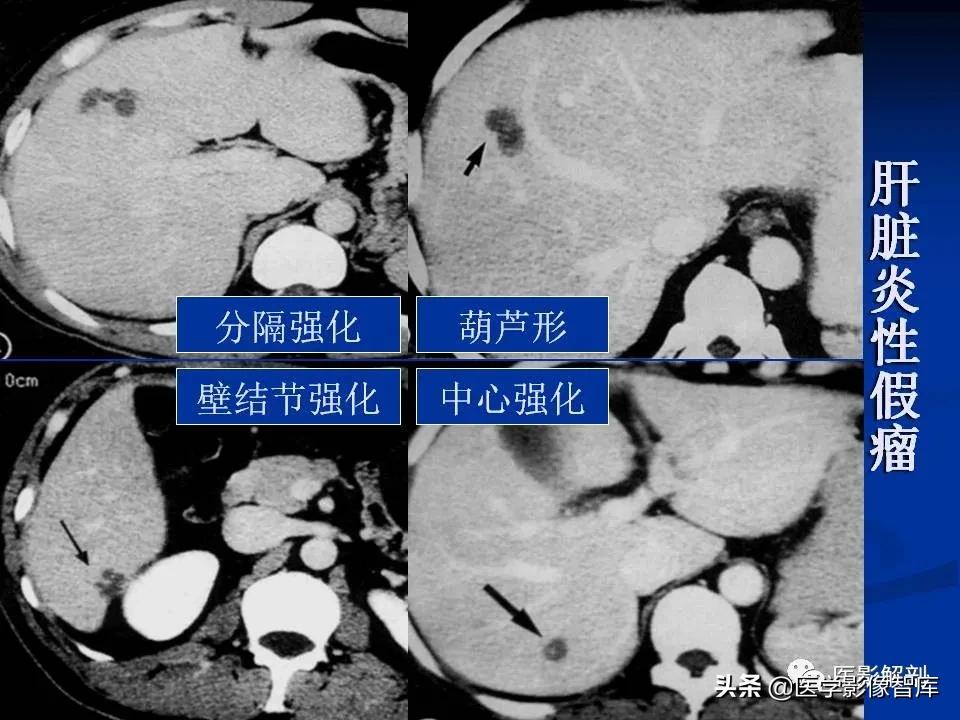 肝炎性假瘤鉴别诊断,肝炎性假瘤影像学表现