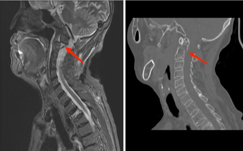 四川南江成功救治一齿状突骨折并寰枢椎脱位患者