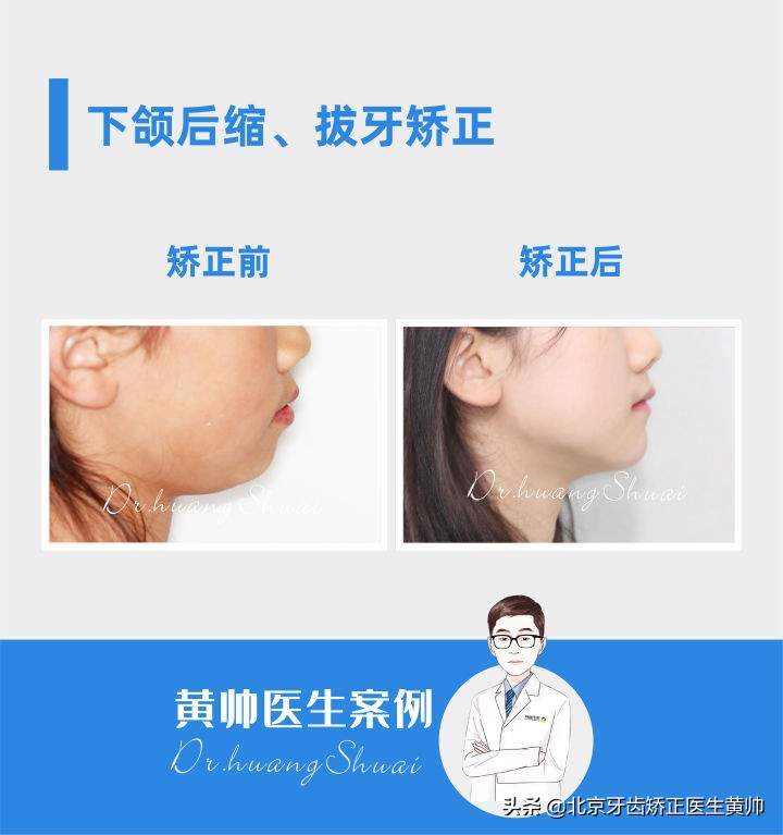 嘴凸的人怎么笑起来好看,嘴凸怎么让自己不焦虑