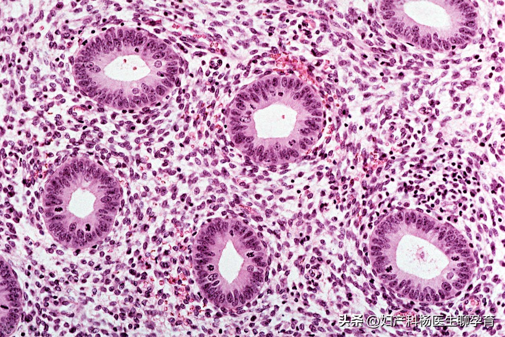 多囊卵巢会影响子宫内膜病变吗,多囊子宫内膜增生严重吗