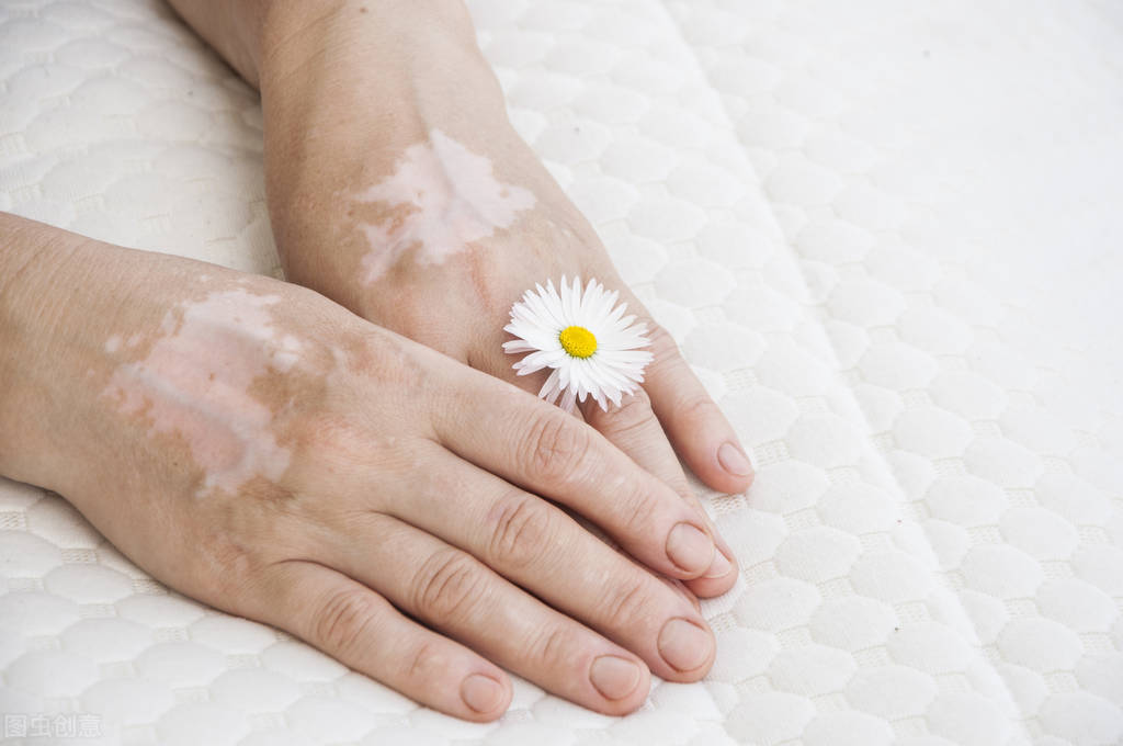 手臂白斑自己又没了,手臂白斑怎么治疗有效