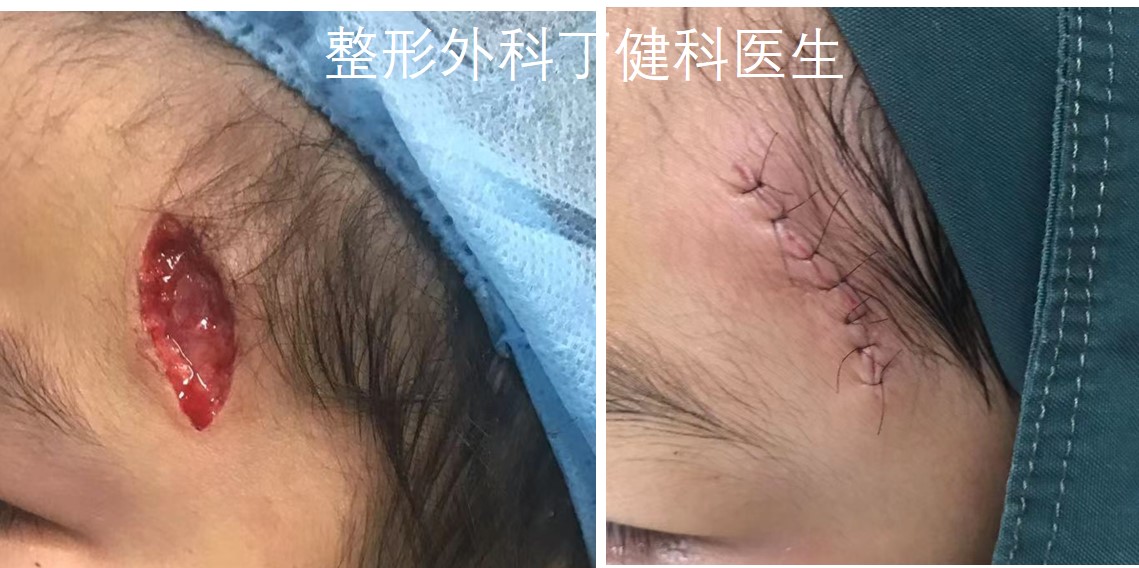 缝合后凹陷疤痕怎么修复儿童,儿童凹陷性疤痕彻底修复方法