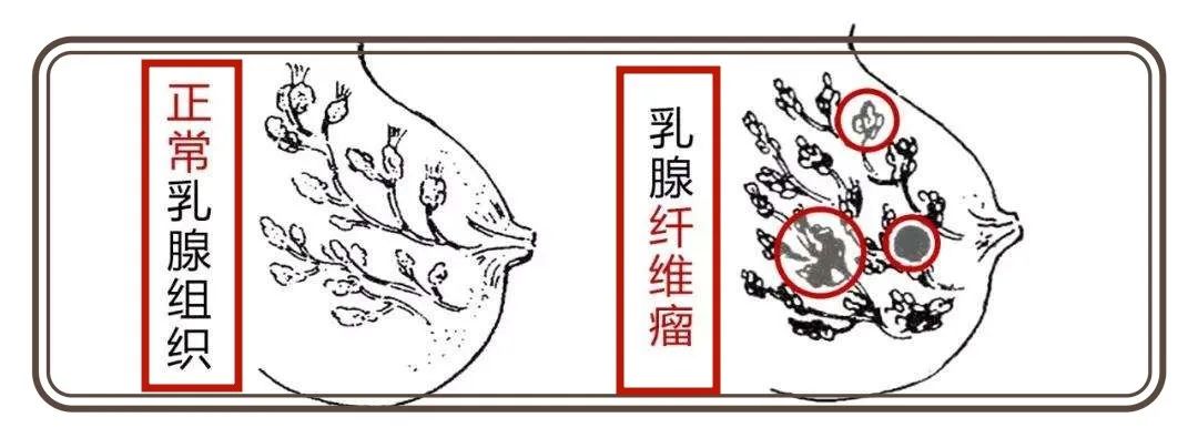 胸小会得乳腺纤维瘤吗,乳房大小跟乳腺纤维瘤有关系吗