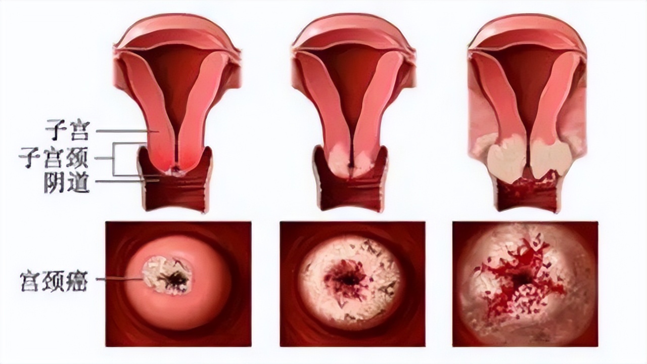 早期宫颈癌变腿上有信号吗,29岁女子查出宫颈癌4个习惯