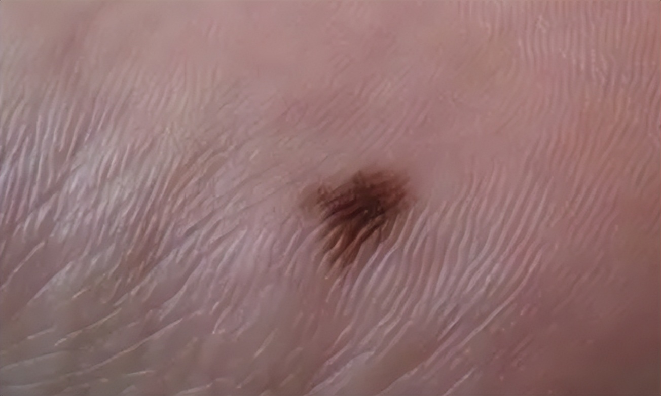 癌前病变和早期癌症有区别吗,癌前病变和癌症有什么关系