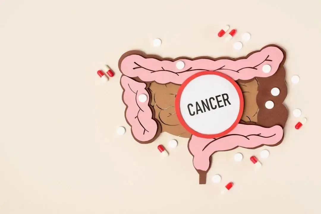 球王贝利结肠癌最早什么时候发现,球王贝利几岁查出来癌症