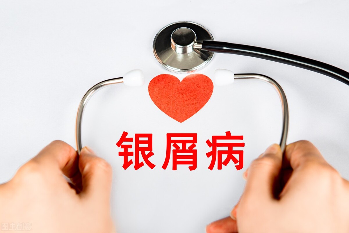 银屑病就是牛皮癣吗怎么治疗,银屑病又叫牛皮癣