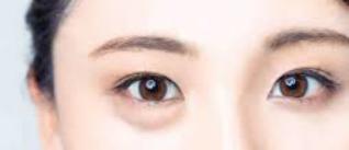 眼袋和卧蚕有什么区别怎么祛眼袋,眼袋可以改善成卧蚕吗