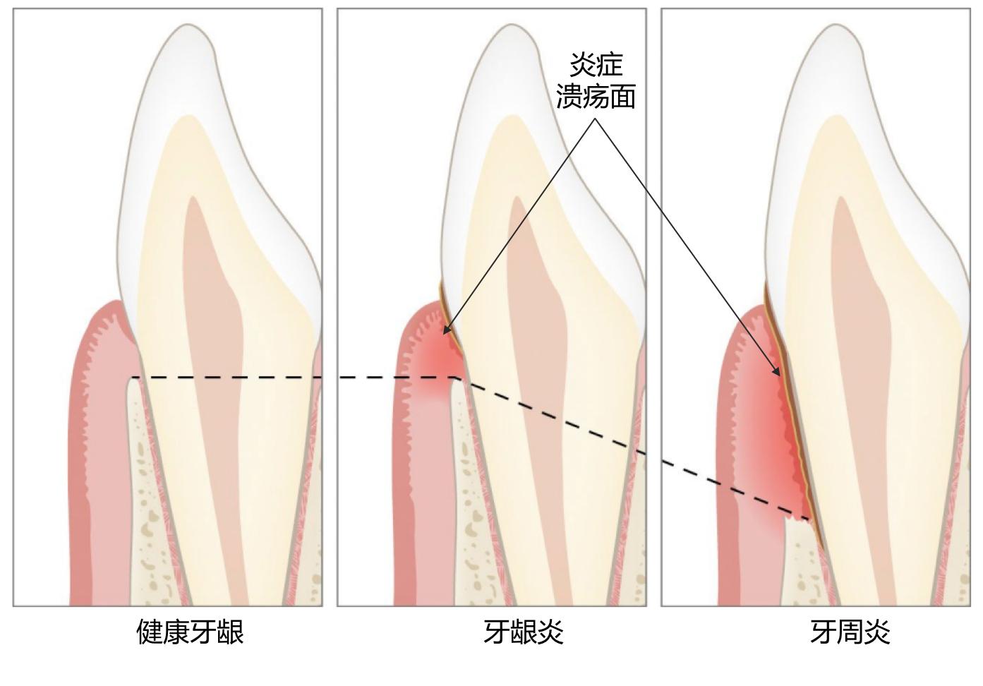 洗牙之后疼怎么办,洗牙疼不疼视频大全