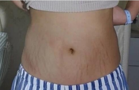 产后如何淡化妊娠纹一个妙招,产后淡化妊娠纹最有效的方法