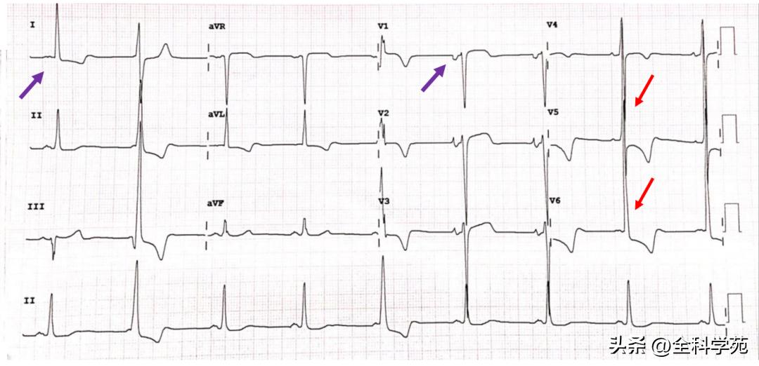 心电图qrs间期变长是怎样造成的,心电图qrs振幅多少是正常范围
