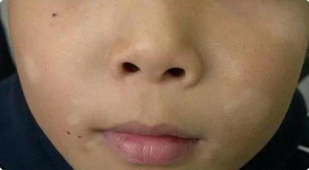 小孩子脸上长白斑需要吃打虫药吗,孩子脸上长斑是该打虫子了吗