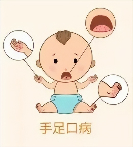 一图读懂手足口病的科普与防护,一医健康科普汇总