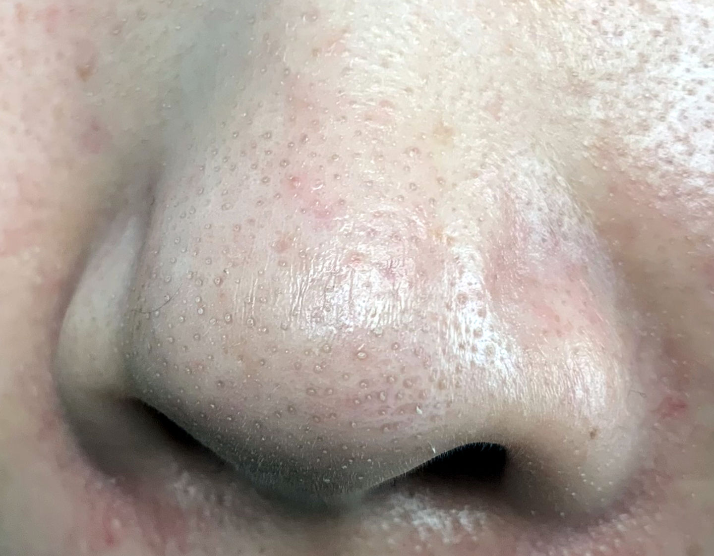 眉心鼻翼和下巴长粉刺为什么,鼻头上起粉刺什么原因引起的图片