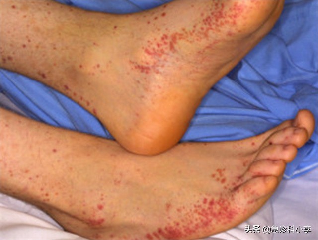 孩子身上小红点不痛不痒是什么病,身上起小红点不痛不痒按压会消失