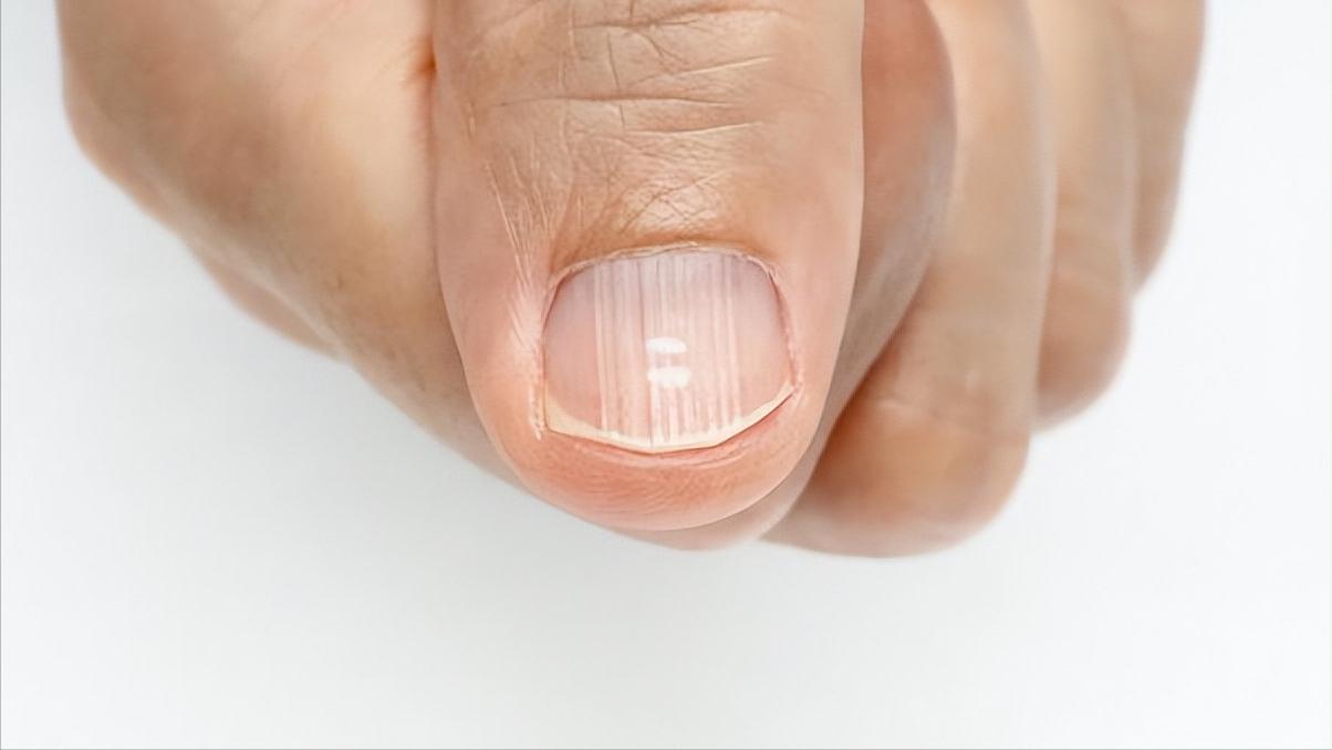 甲沟炎如何快速拔出脚趾甲,脚趾甲老往肉里钻一碰还疼