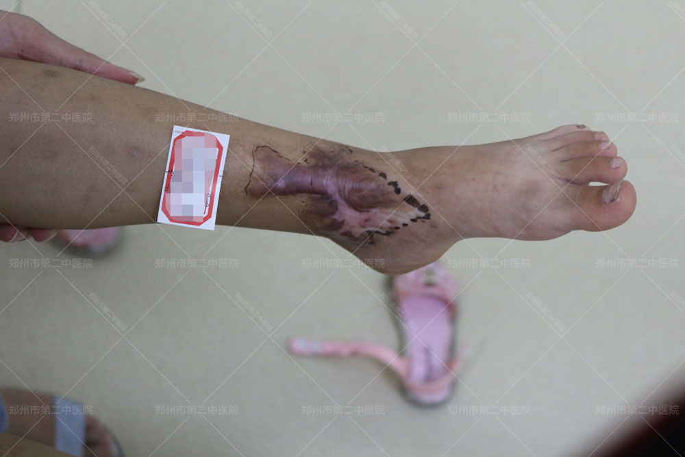 郑州第二中医院疤痕,郑州烫伤疤痕哪里看
