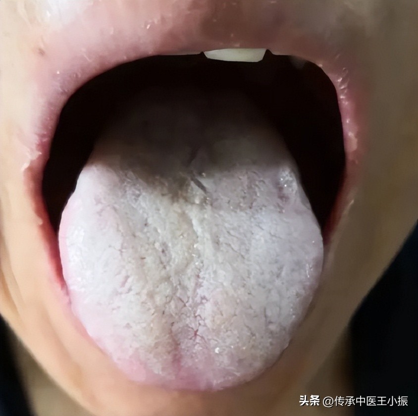 吃附子理中汤排寒反应,脾胃虚寒为什么喝冷水感觉不舒服