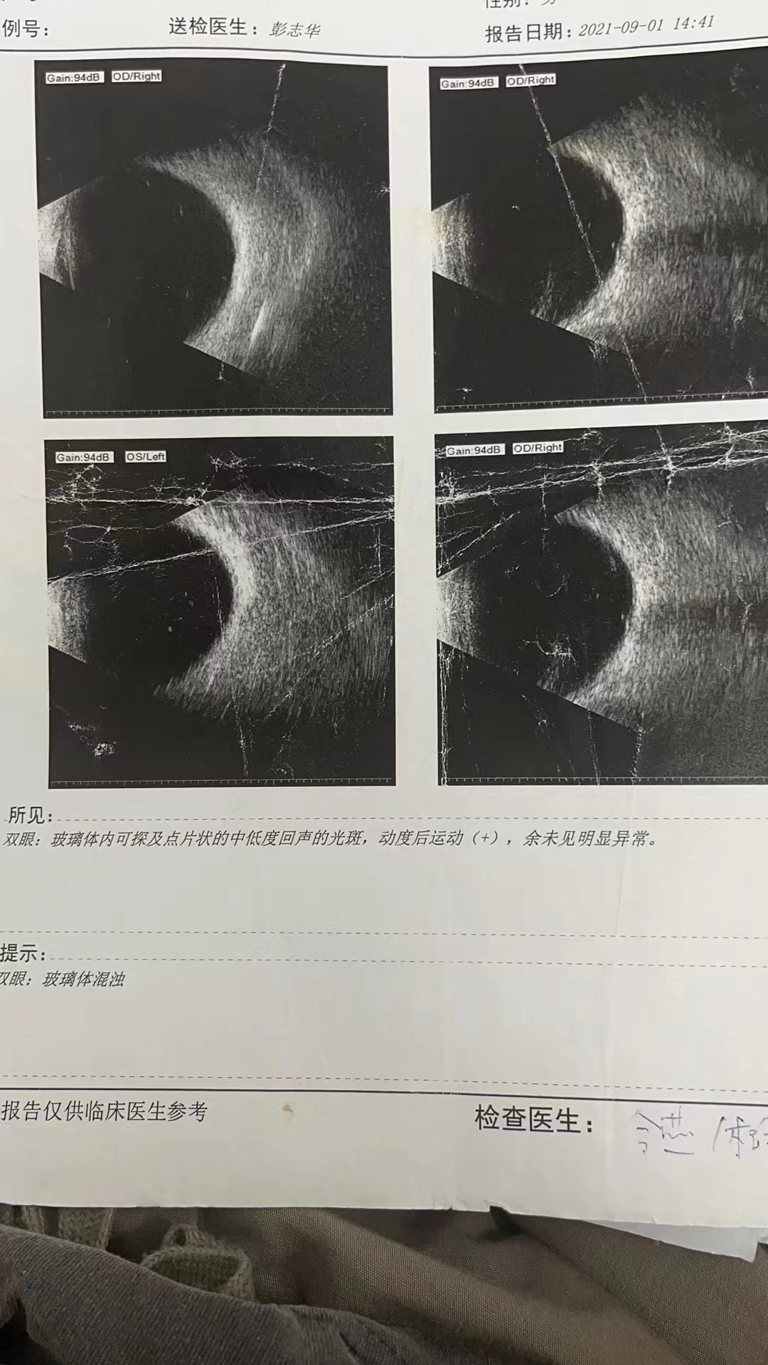 做黄斑裂孔手术是否能引起失明,女子做近视手术后又近视后续