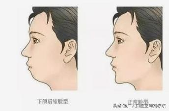 成年以后再矫牙？专家：太迟了，下巴后缩最佳治疗时间是这个时候
