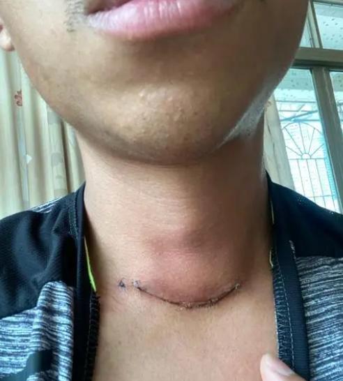 男子被诊断出患有甲状腺癌，手术后报销只需三四千元