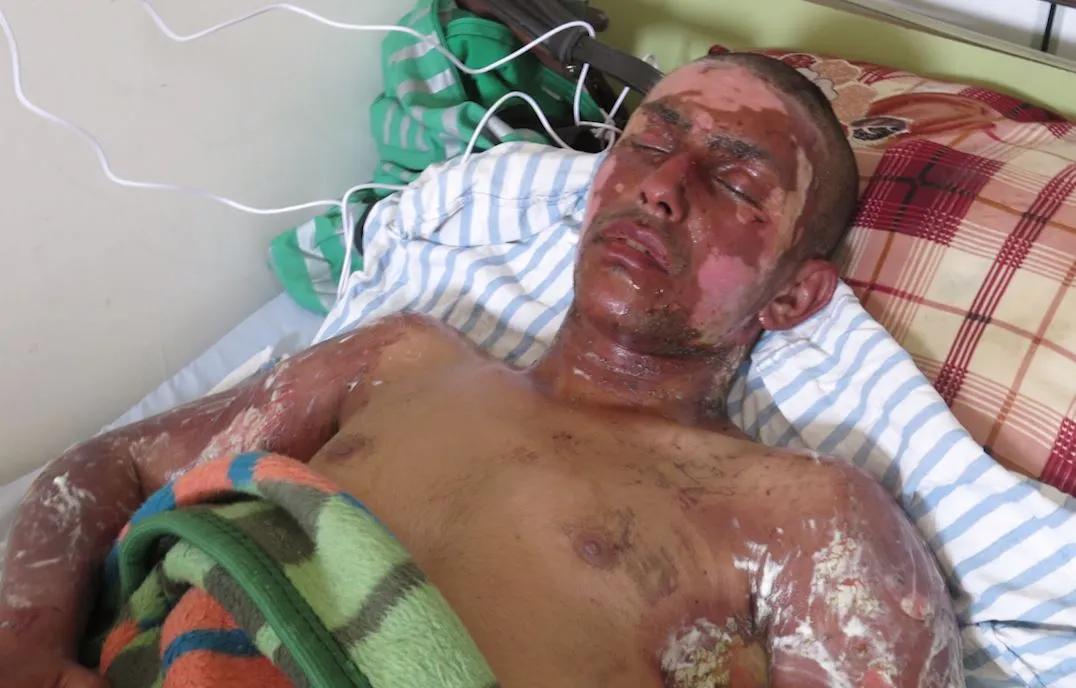 人的皮肤碰到草甘膦会中毒吗,人的皮肤碰到硫酸