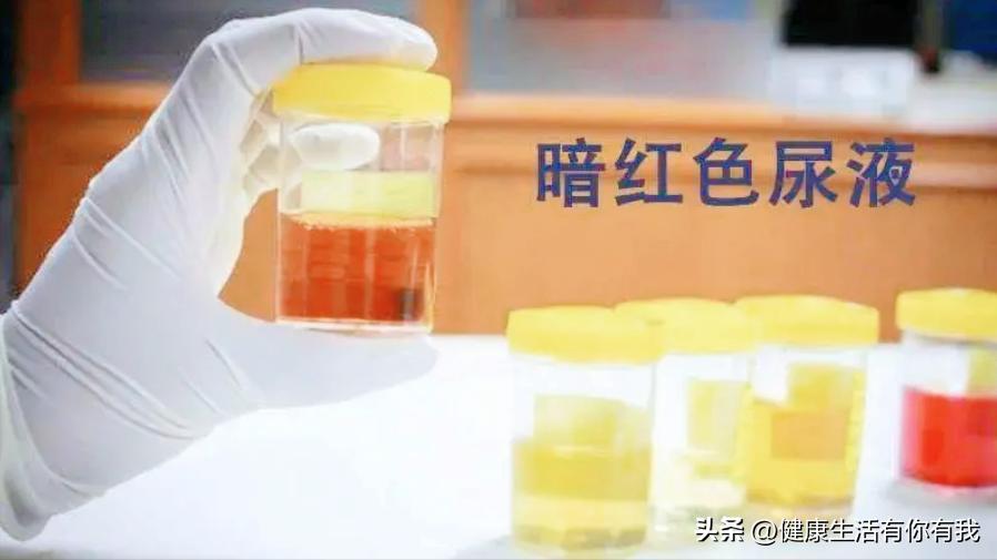 什么是血尿和尿潜血,什么是血尿是怎么回事