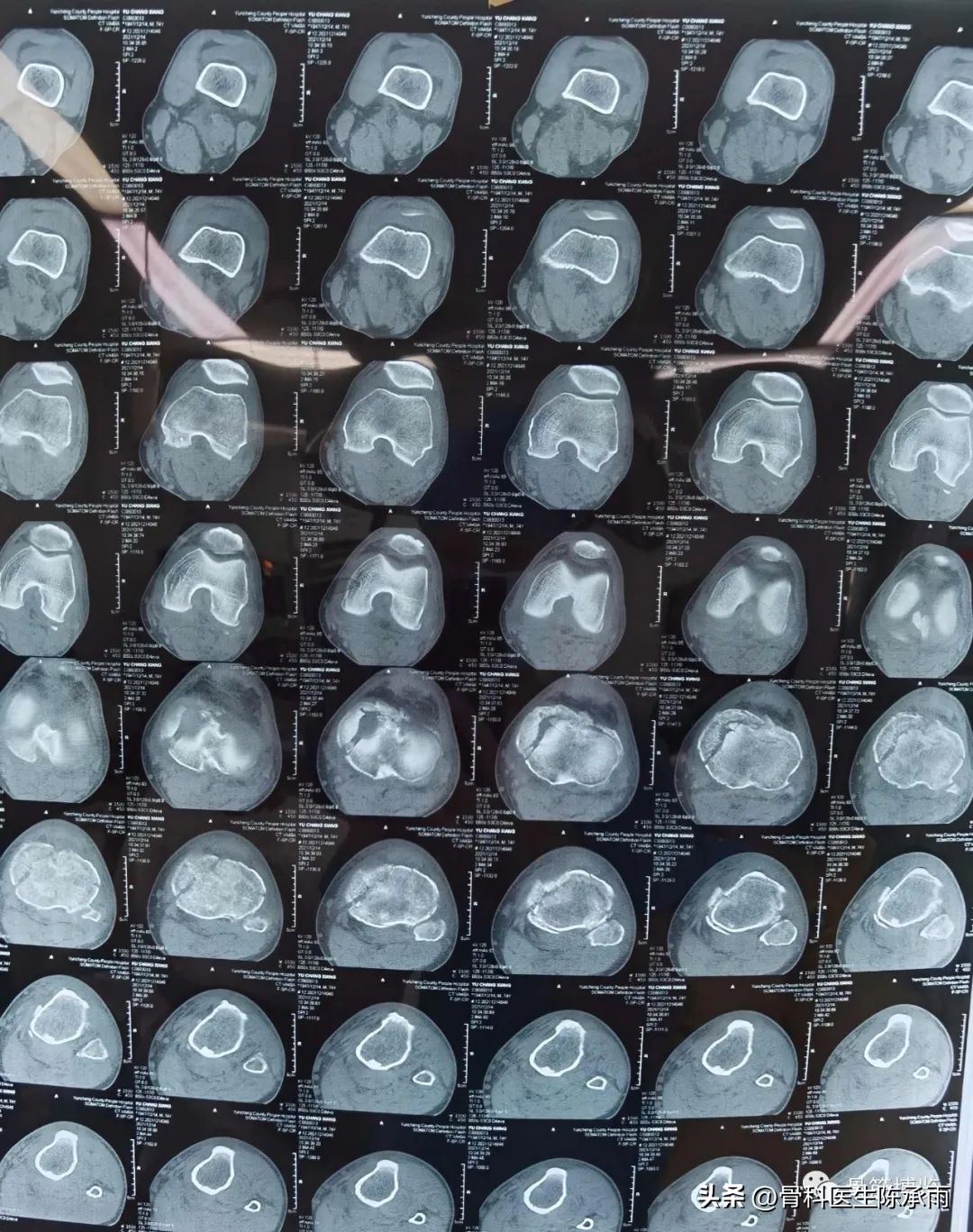 膝关节胫骨平台骨折,最近胫骨平台骨折视频