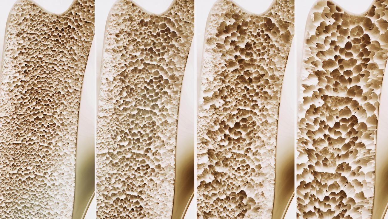 骨量减少怎么补充钙和d3,骨量减少了补钙还能恢复吗