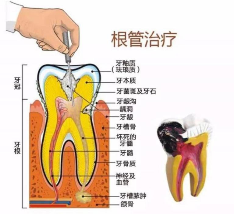 根管治疗对医生来说难不难,根管治疗都有啥费用