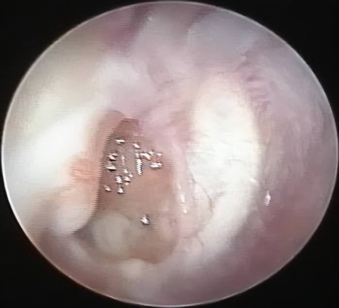 中耳炎耳内镜微创手术,慢性中耳炎流脓能做微创吗