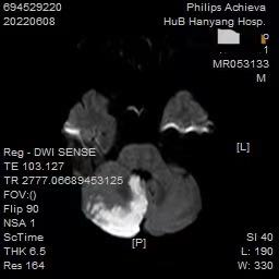 头晕怎么缓解眩晕,头晕和眩晕的区别警惕三种病