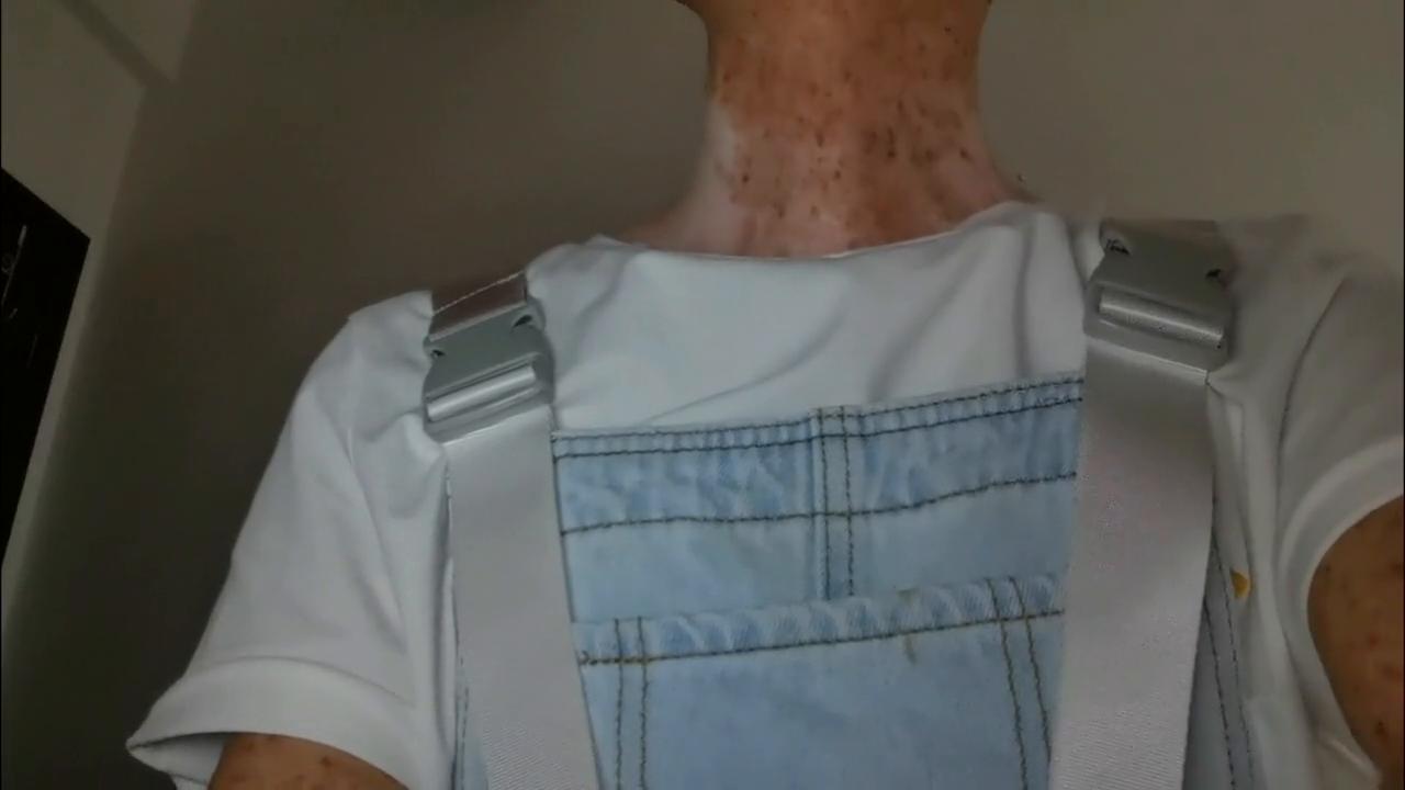 除了接受,还能怎样!!!#着色性干皮症