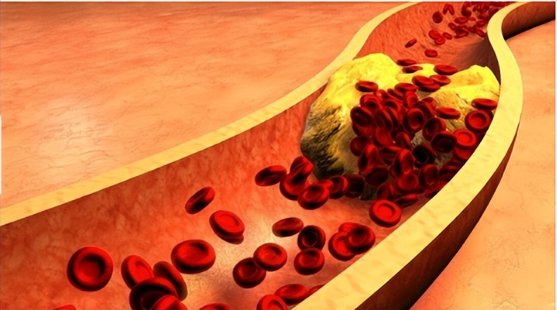 身体出现6个症状暗示猝死降临,身体出现这6种信号警惕猝死