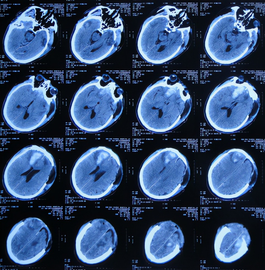 脑外伤后硬膜下积液颅骨修补,颅骨修复手术失败导致脑积水