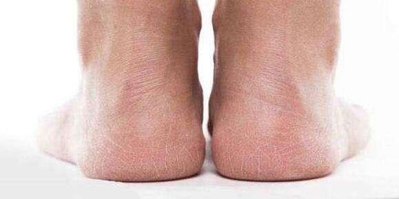 脚后跟干裂是缺什么营养吗,脚后跟干裂起皮一个方法帮你解决