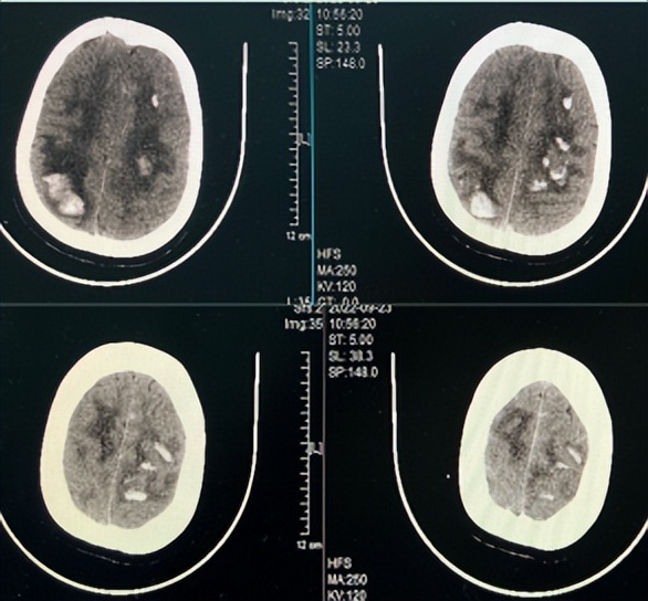 重症监护室救活孕妇故事,急救危急重症孕产妇途中分娩