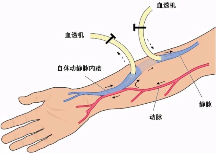 血管造瘘透析,血管人工搭桥