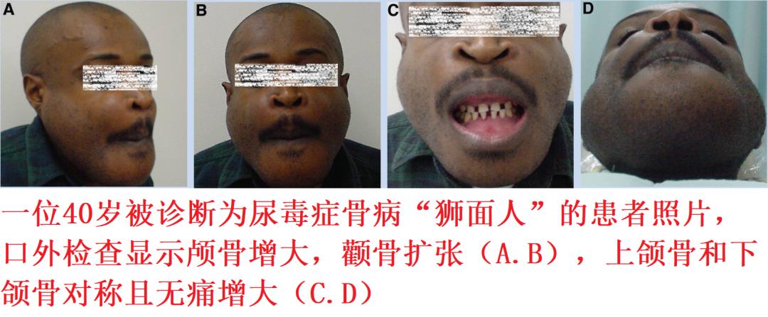 别的指标正常就是肌酐高怎么回事,这项指标升高需警惕前列腺癌