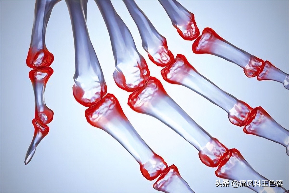 类风湿能终身不复发吗,类风湿关节炎停药多久能要小孩