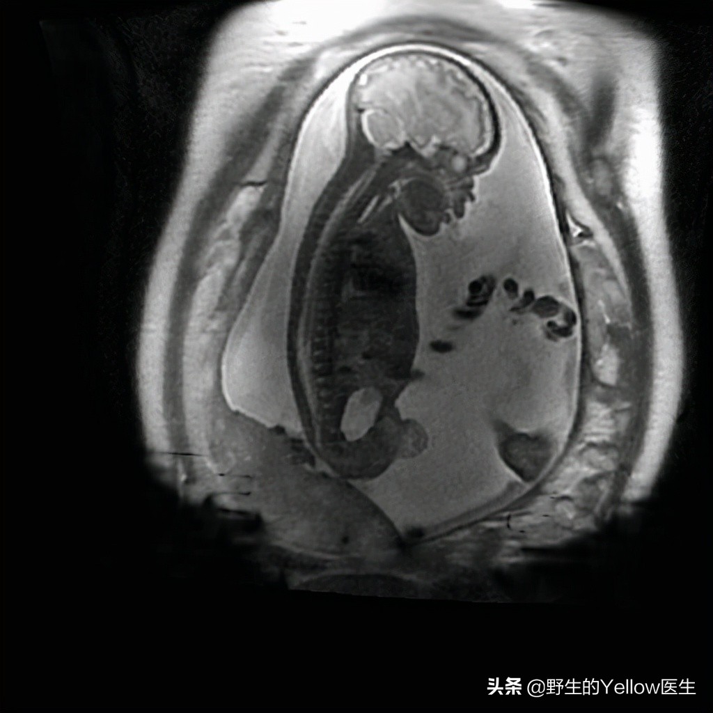 磁共振mra和mri检查没有问题,磁共振mri注意事项