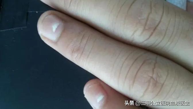 手指甲出现横纹预示身体怎样,手指甲有凹凸竖纹正常生理现象
