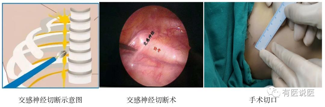 手汗症小知识,手汗症解决方法解析