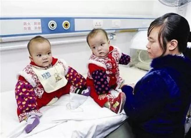 中国首例坐骨连体婴,坐骨连体姐妹分离成功了吗