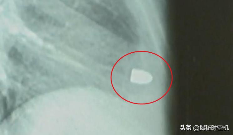 中国孤例！*弹子**击中心脏14年没死？湖南男子奇迹生还至今成谜