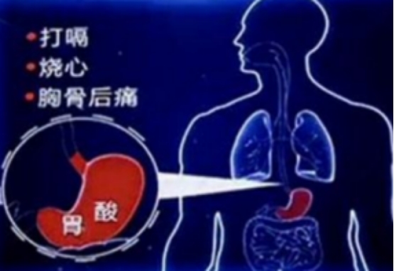 胃食管反酸烧心怎么治,总烧心胃反酸吃什么药