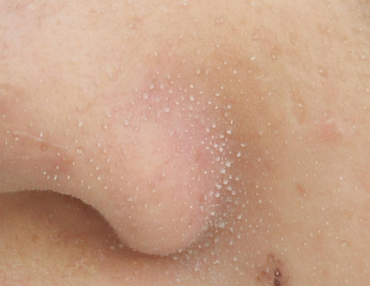 黑头没挤干净怎么办,黑头没及时处理变成黑痣了怎么办