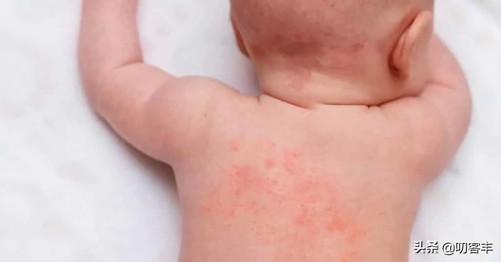 孩子痱子有什么特效药,孩子脸上长了很多小颗粒像痱子
